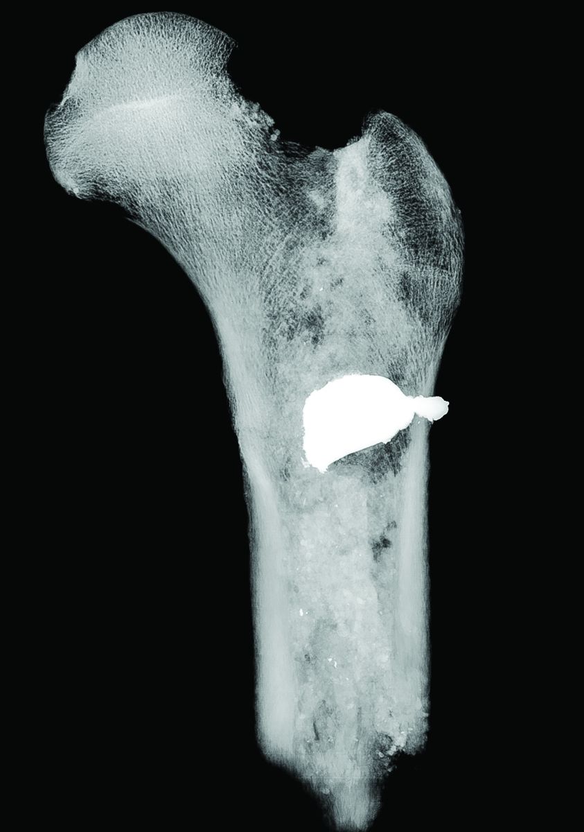 Left: An Enfield bullet embedded in the badly fractured right femur of one of the men dates the pit (Kate D. Sherwood, Smithsonian Institution) Right: X-ray showing the position and distortion of the embedded bullet. (Smithsonian Institution)