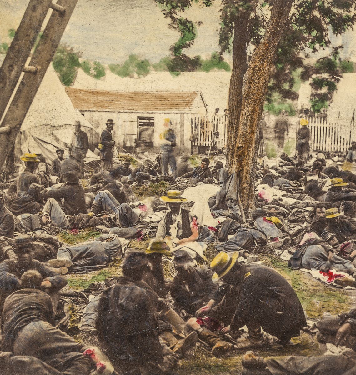 Hand tinted photograph of wounded Union soldiers at Savage’s Station, Va., during the Peninsular Campaign. (Library of Congress)
